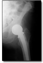 Hip Implant